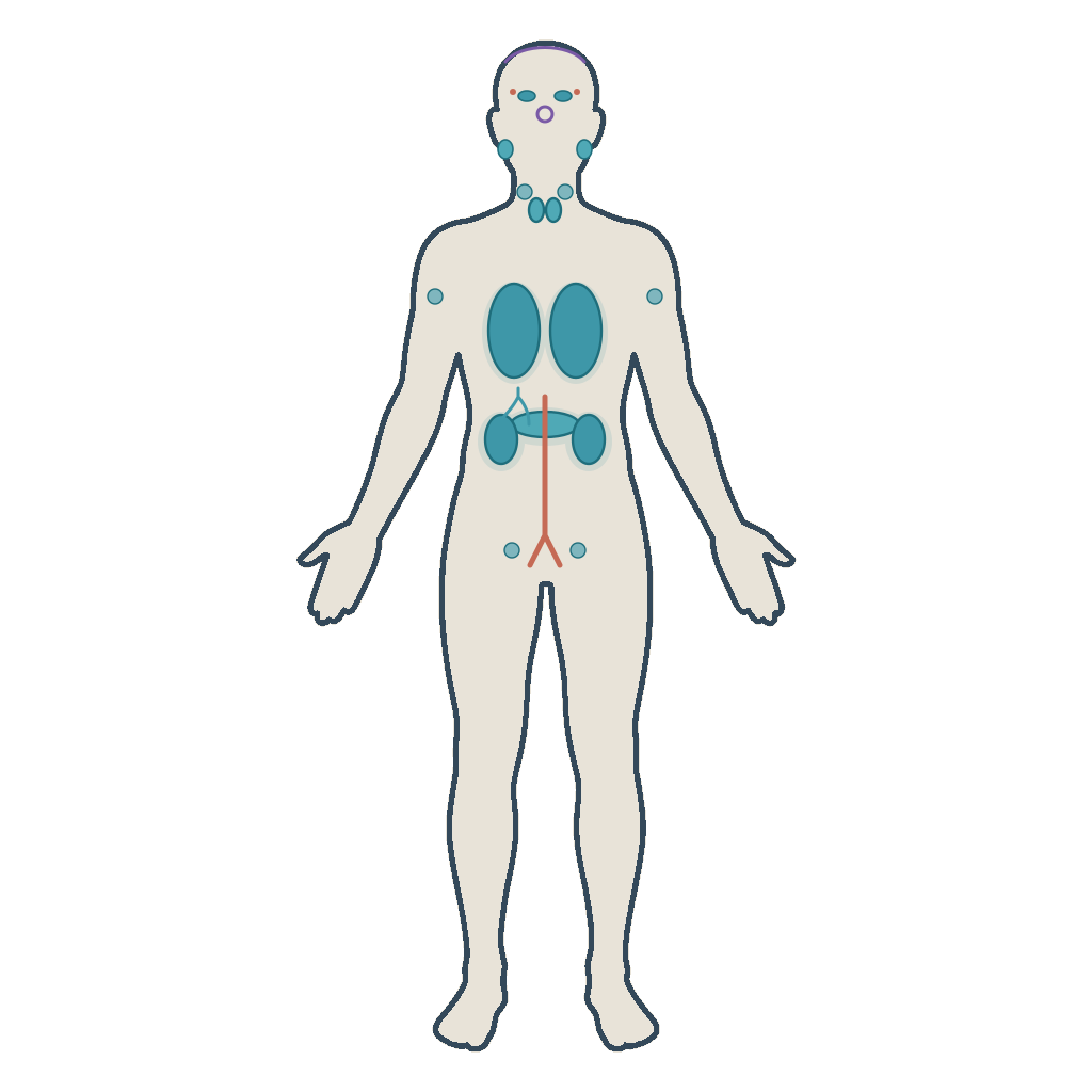 Ilustración de un cuerpo humano que muestra las zonas que puede afectar la enfermedad relacionada con IgG4.